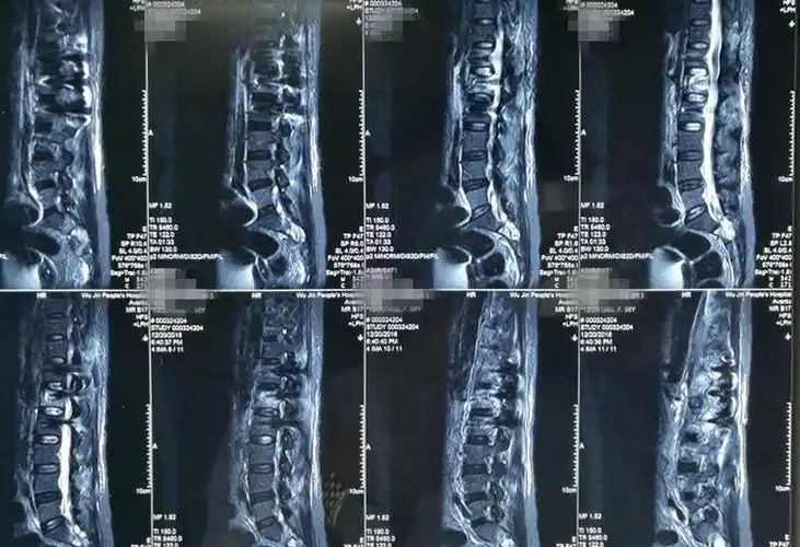 胸腰椎骨折的治疗科普