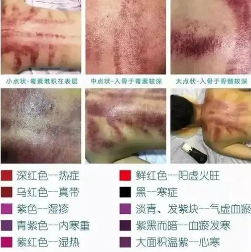 刮痧界爱马仕一块可以加热的天然砭石推刮仪刮出全身湿气毒素一身轻松