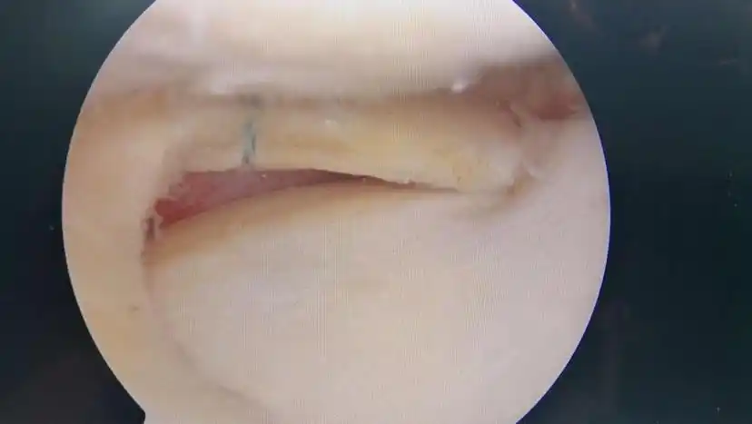 经mri和关节镜确诊为内侧半月板损伤,内侧滑膜皱襞,滑膜炎和腘窝囊肿