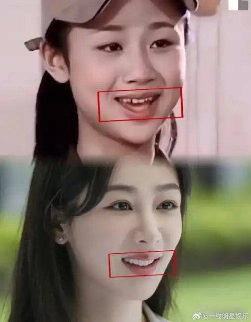 杨紫采访的时候也说过她在亲爱的热爱的之后矫正的牙齿,虎牙挺可爱的