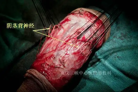 治疗早泄的新技术——阴茎背神经选择性切断术简介_早泄_手术_治疗