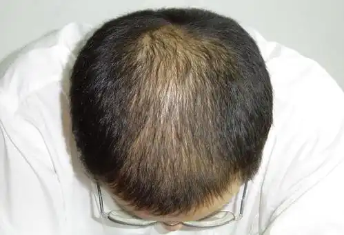 20岁大学生雄激素性脱发2年,现在已经秃顶了,自卑到不敢跟人交流