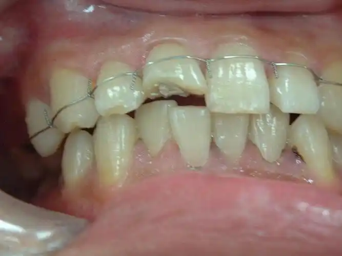 五,松牙固定术ppt