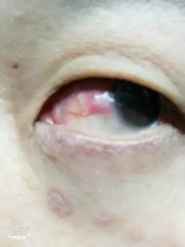 白眼球上长了个这个(有图),请问是什么,求偏方