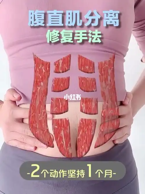 腹直肌分离修复手法