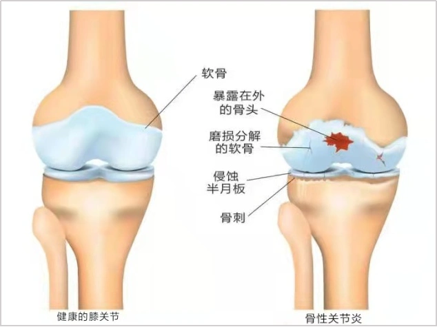 一半以上的老年人患了这个病,寸步难行|骨性关节炎|膝关节炎|关节腔