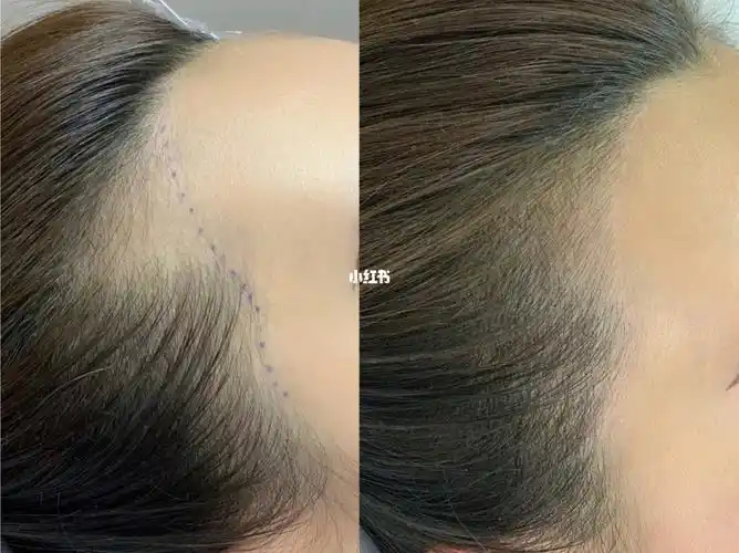 纹发际线前后对比