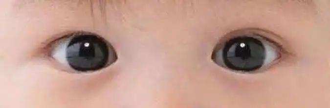 如何判断有没有"内斜视"_共同性内斜视 - 好大夫在线