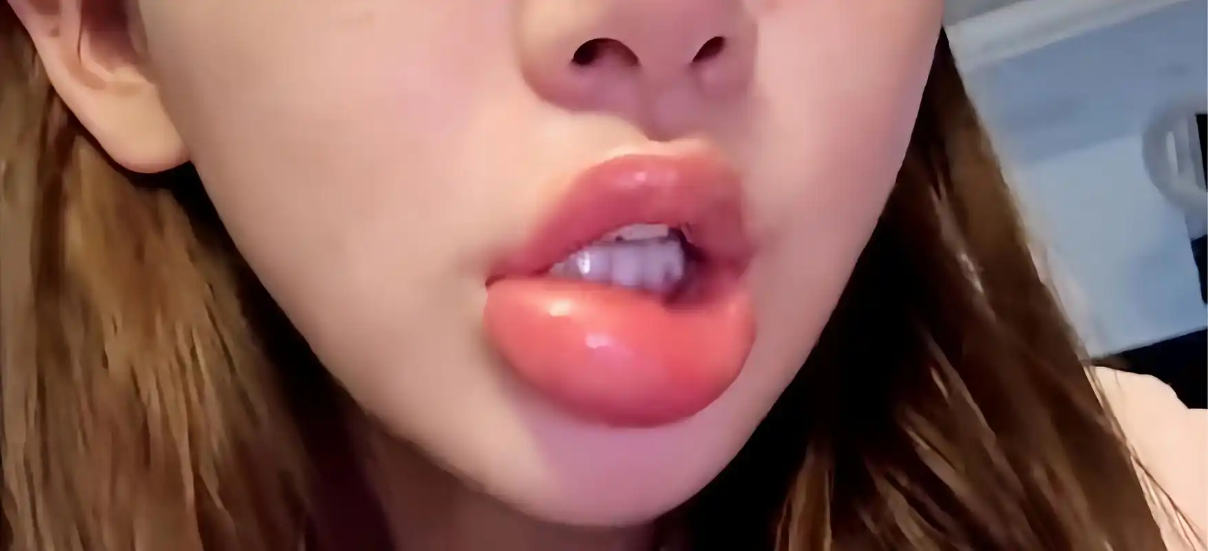 女生半夜嗦田螺肿成香肠嘴  嘴巴肿成"香肠嘴"引发关注,女子猜测田螺