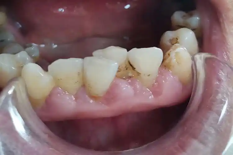 牙龈肉芽增生图片