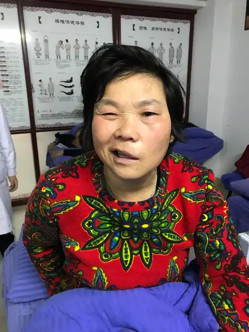 患者面瘫一周前来就诊.