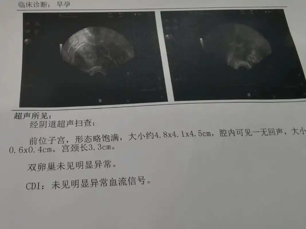 孕35天做了阴超,发现了孕囊,排除宫外孕 停经6天,孕35天,晚上下腹部