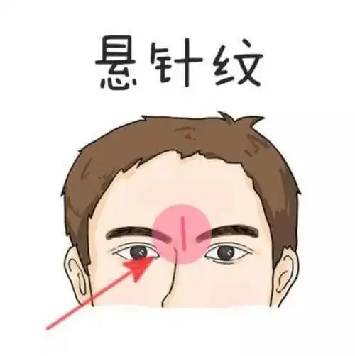 悬针纹自己消除方法,怎样去除悬针纹