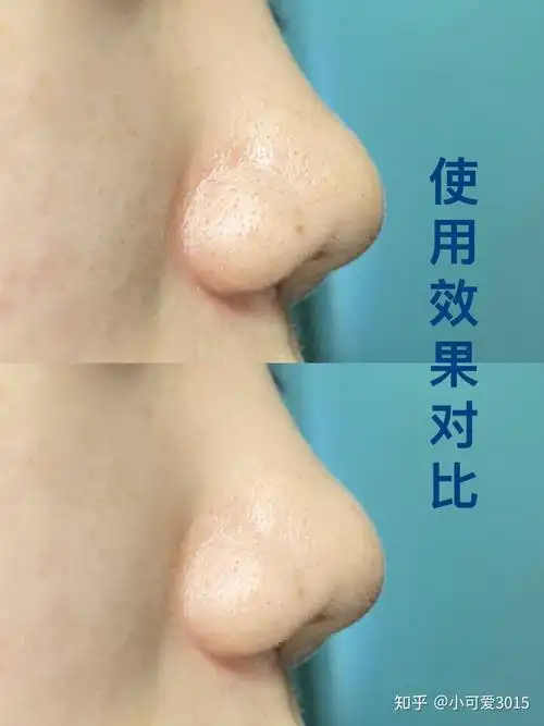 黑头仪究竟是不是交智商税 - 知乎