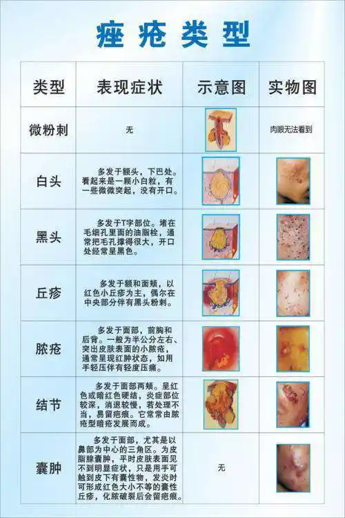 治疗扁平疣青春痘痤疮