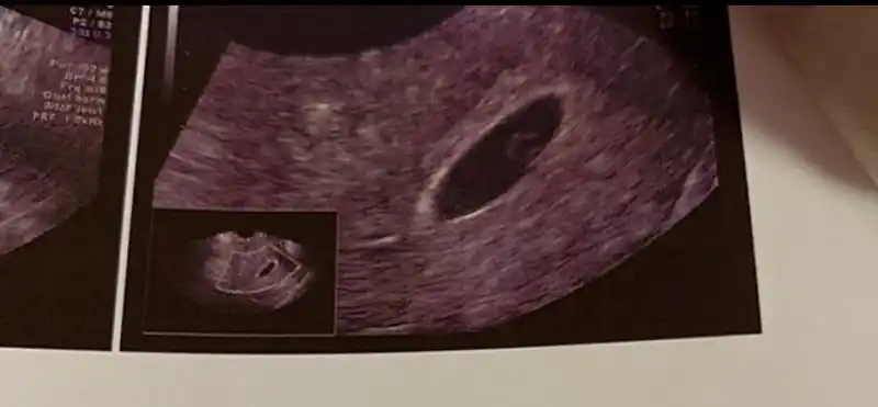 四十天的胎囊21×7×23大家帮忙看下男孩还是女孩?