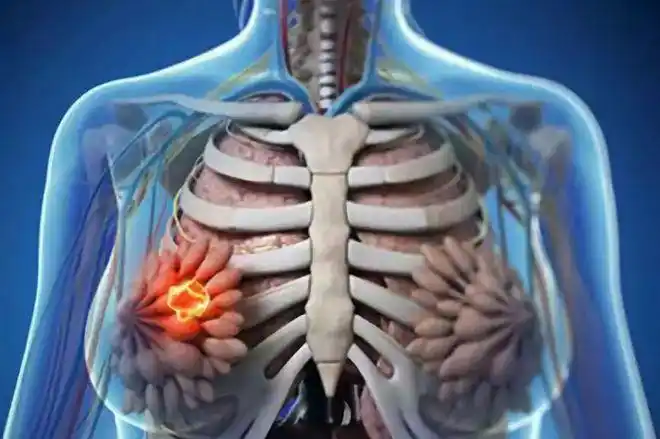 与女性相比,男性乳腺癌患者的死亡率更高.