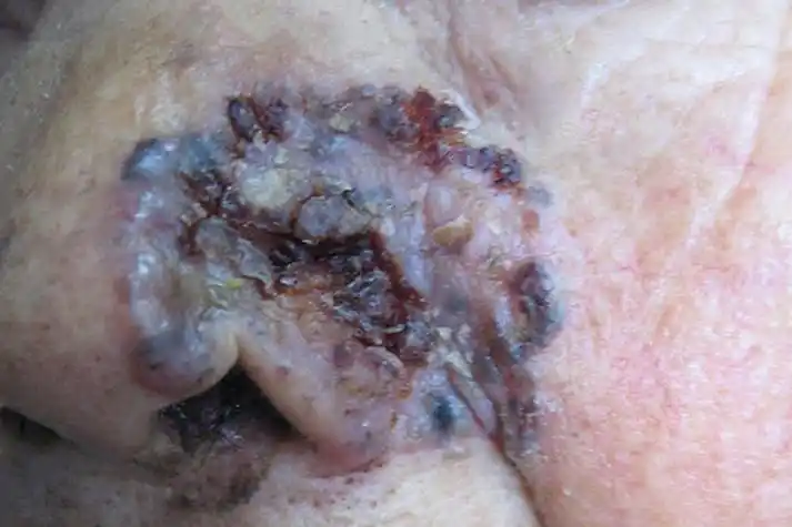 皮肤癌早期症状图片