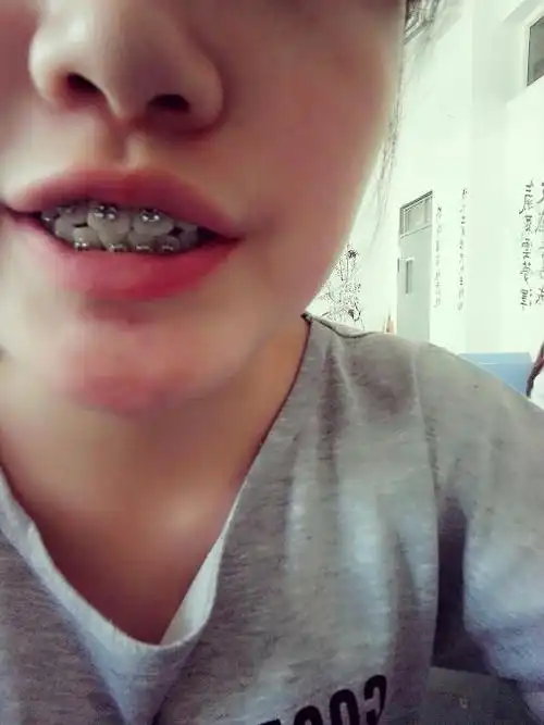 大家好,我今年12岁,门牙俗称为兔牙,暑假想去矫正,门牙中间有条缝