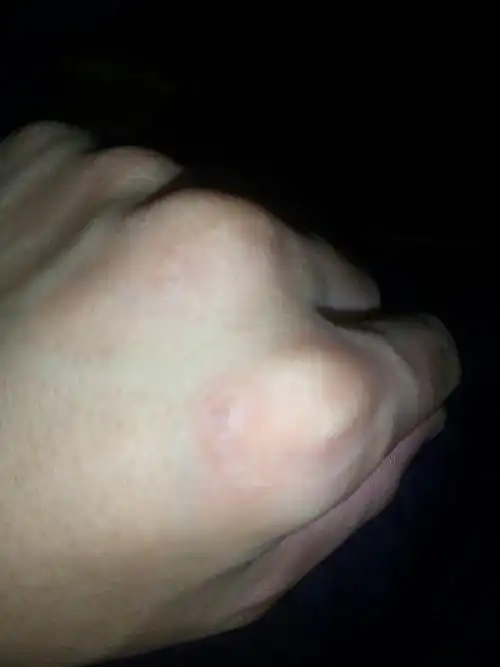 手伤疤怎么祛除?