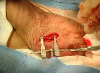 睾丸畸形的介绍