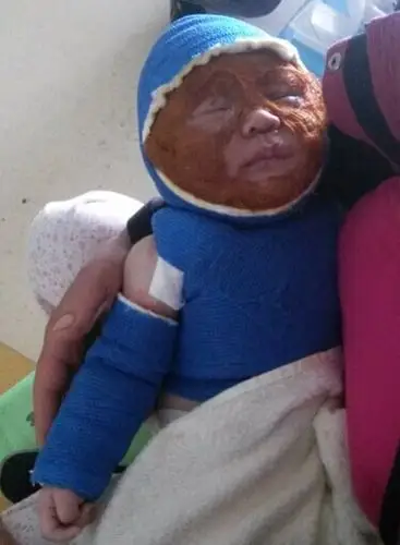 大人拍照忘关闪光灯 3个月宝宝眼睛被灼瞎