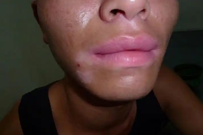嘴角部位白癜风白斑图