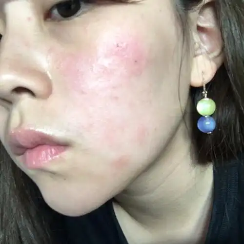 过敏烂脸到痊愈的全过程 敏感肌肤妹子来看 图真慎入_敏感肌_洗面奶