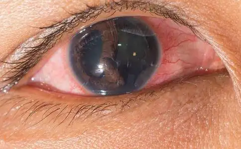 红眼病的症状-学路网-学习路上 有我相伴