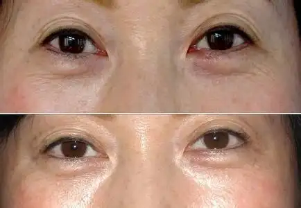 去除眼角皱纹的前后对比图