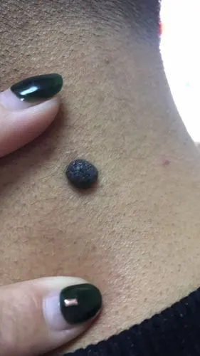 长成这样的黑痣,小心黑色素瘤!