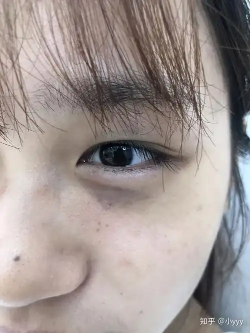 眼角黑的一点一点的是黑色素沉淀还是毒素啊? - 知乎