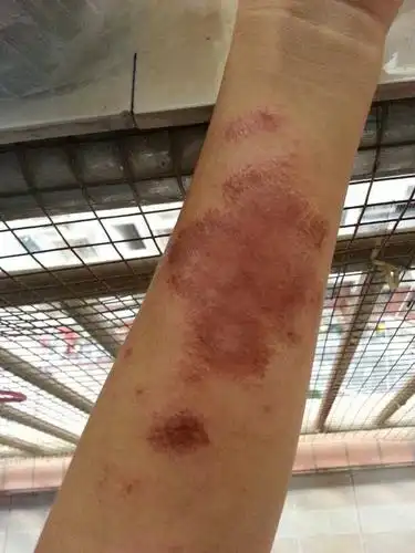 有见过这么严重的湿疹吗?图片有点恶心,不喜勿进