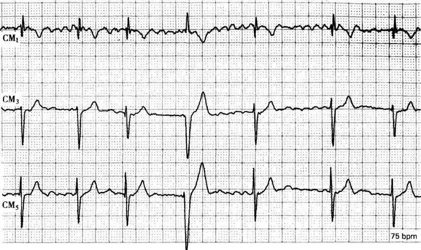 医学 心律失常 正文 【心电图特征】快速,不规则的心房颤动,频率460次