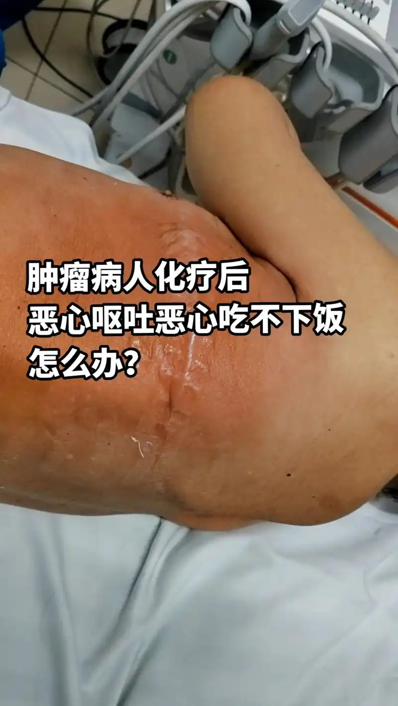 恶心呕吐恶心吃不下饭怎么办肿瘤病人化疗后