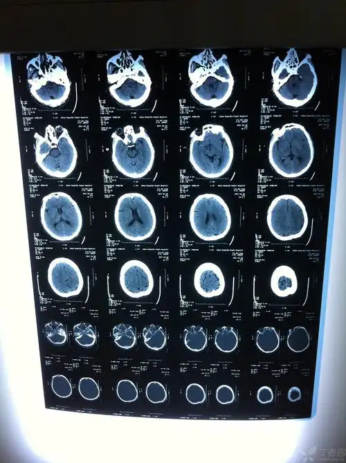 【病例讨论】大面积脑梗塞溶栓1例 [病例帖]