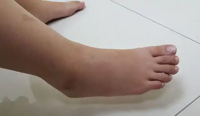 销售员右脚踝扭伤肿大.