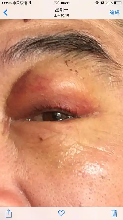 眼睛受伤,见证精油的强大力量