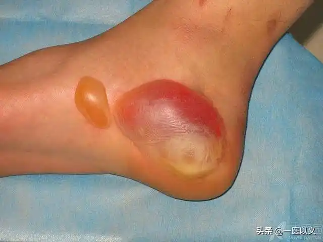 疫情期间:别只顾着做菜,热水,油烫伤怎么办?水泡要不要刺破?