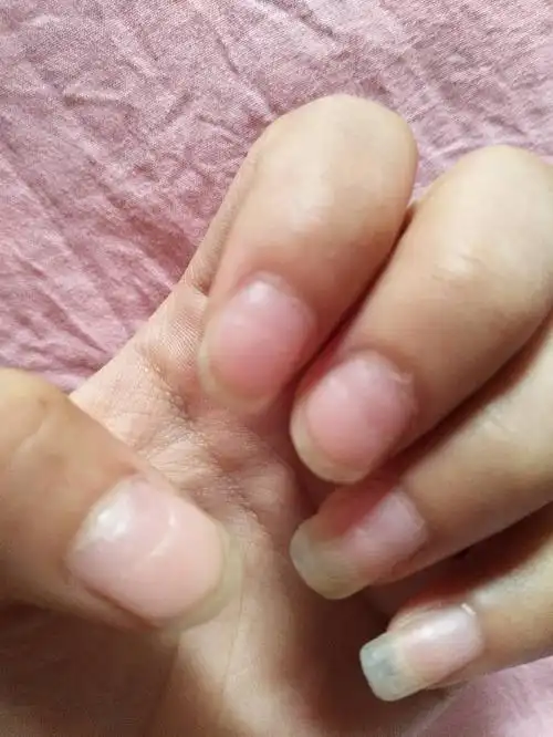 每个指甲盖中间都有一道这样的凹梗,我是不是身体出什么问题了?