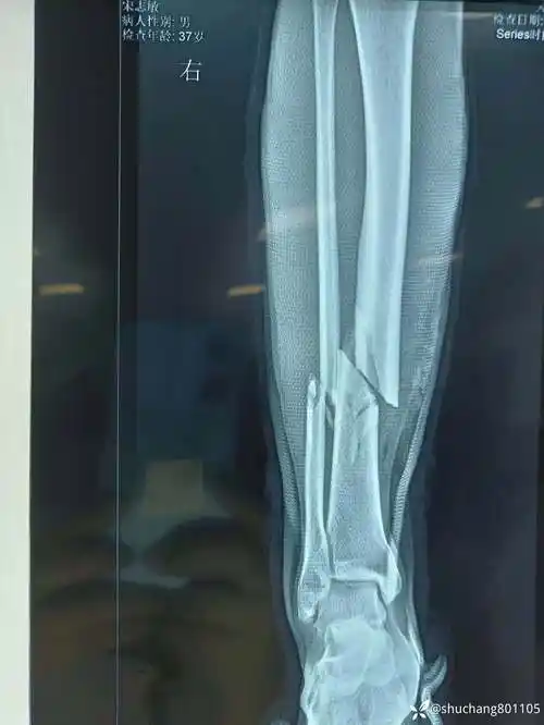 右胫腓骨下段开放性骨折治疗方案