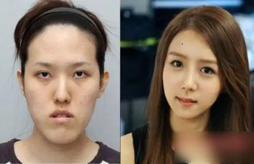 丑女变女神图揭韩国震撼整容术8