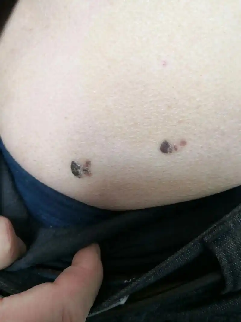 这种躯干部位的黑褐色斑块多见于脂溢性角化 - 抖音