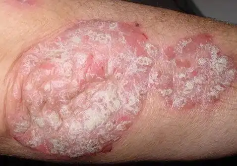 斑块型银屑病长什么样