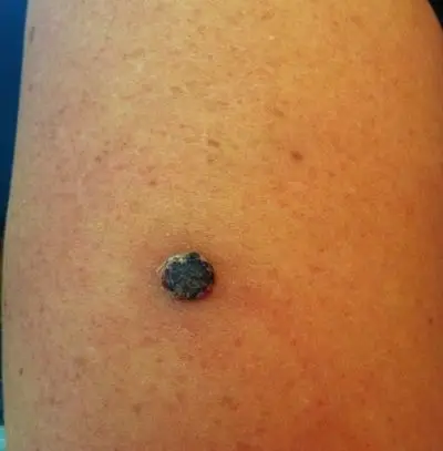 容易癌变的黑痣图片6