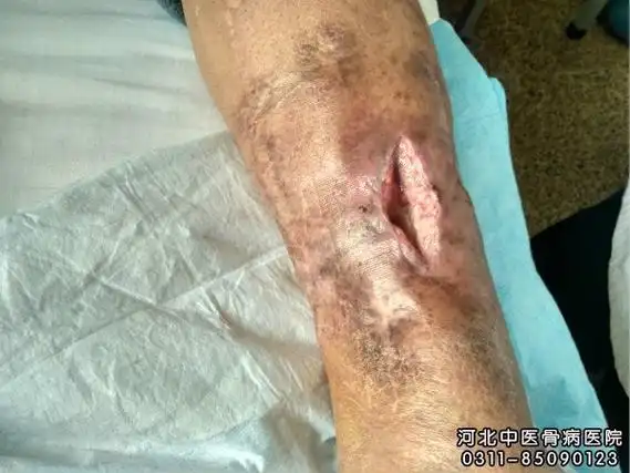 骨髓炎患者的伤口处