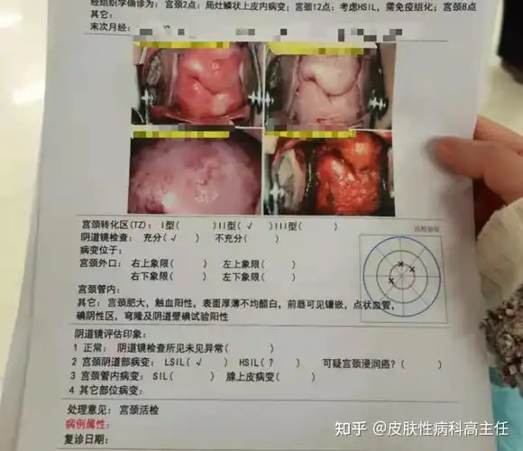hpv1618阳性转阴啦甩掉渣男约到小虎宝