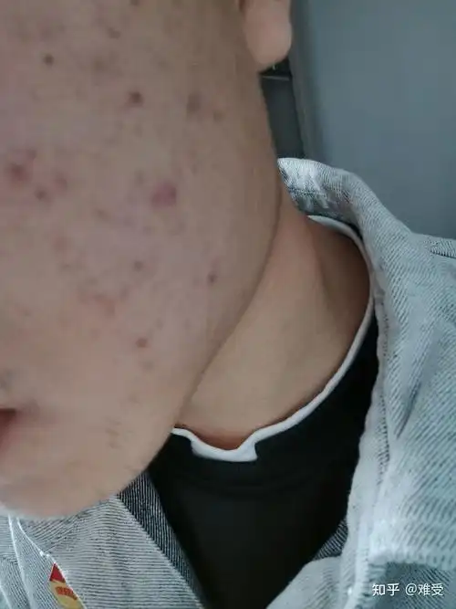 丑男,不知道这个相机滤镜咋搞,皮肤很差,鼻子塌,脸大,还比较矮