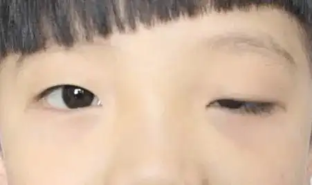 孩子大小眼看起来像睡不醒警惕这种眼部疾病严重了会弱视
