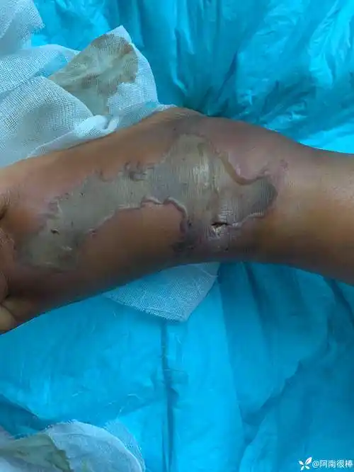 毒蛇咬伤后感染皮肤组织坏死植皮术前术后对比